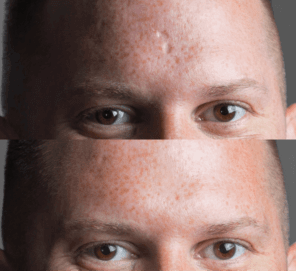 Dermaflage Before and After: Confidence.