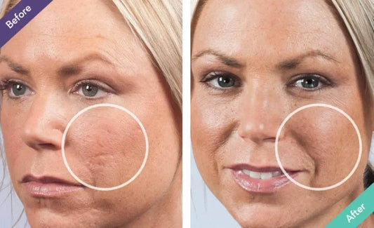 scar filler for rolling acne scars