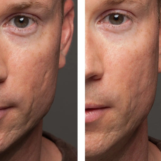 How to Get Rid of Acne Scars
