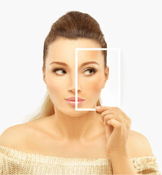 hyperpigmentation