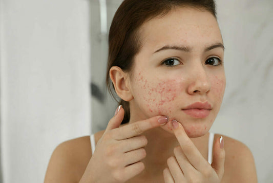 What Would You Accomplish if You Didn’t Have Acne Scars?