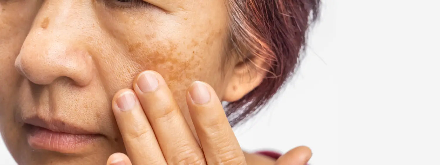 best concealer for melasma