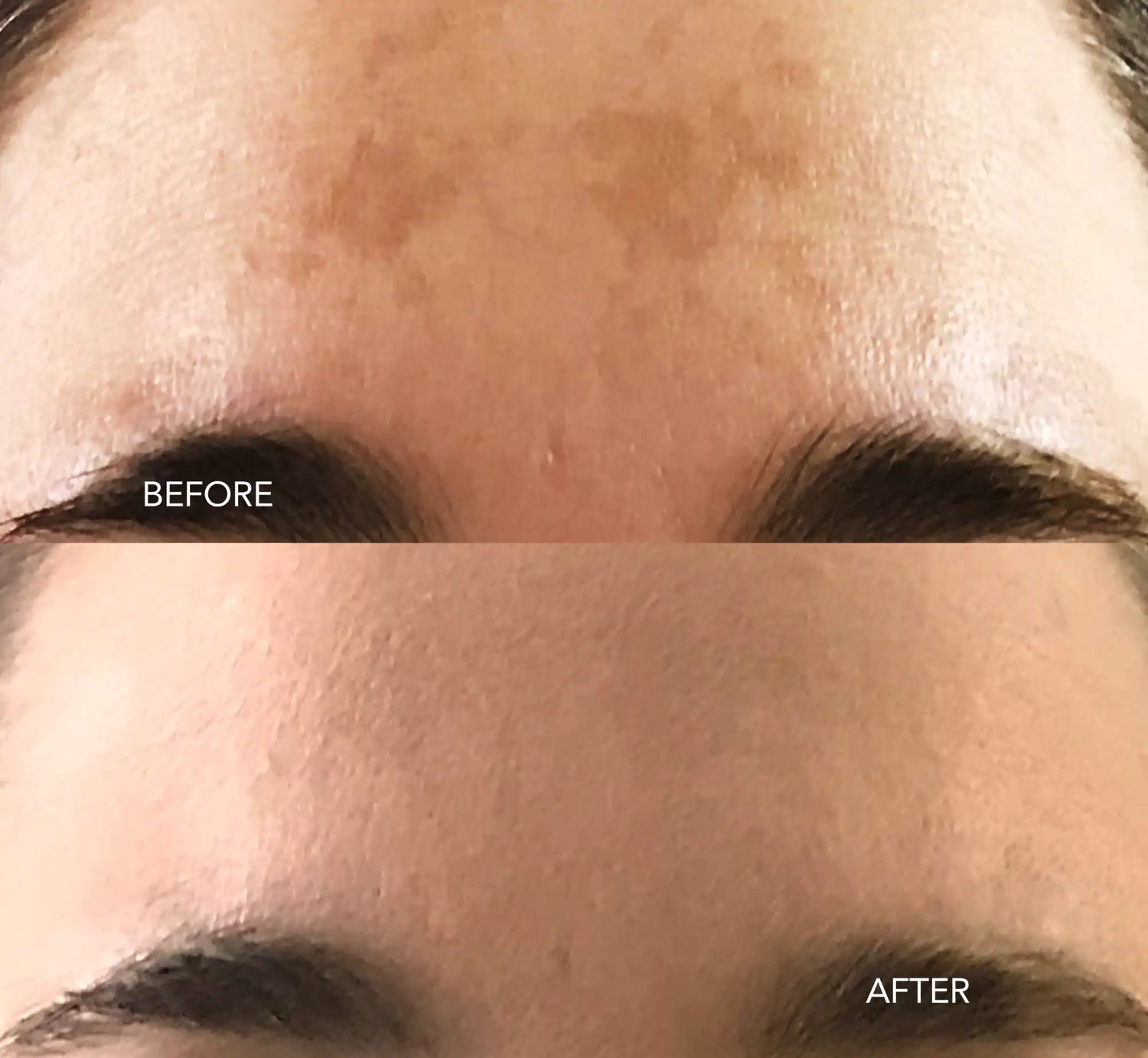 melasma