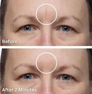 wrinkle filler