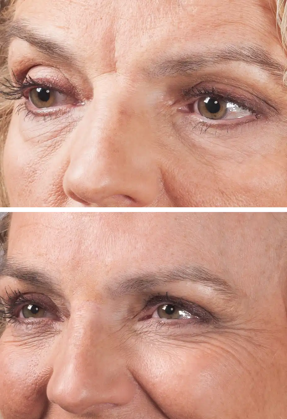 wrinkle filler