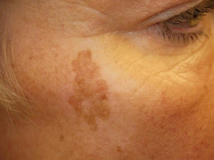 Achieve Flawless Skin Every Day: Finding The Best Concealer For Age Spots