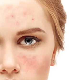 Celebrities with Acne