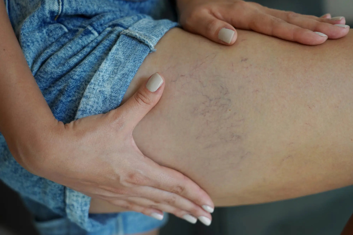 spider veins