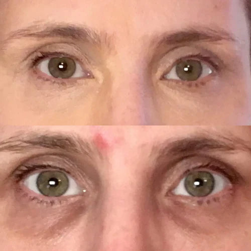 DARK UNDEREYE CIRCLES