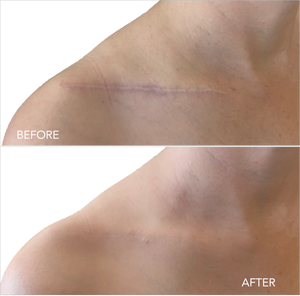 Makeup for Scars - Conceal like a Pro!