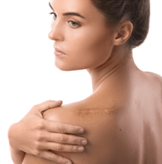 keloid scars