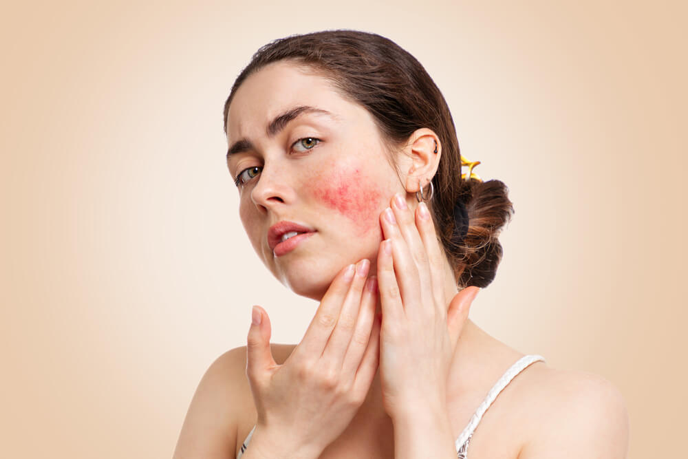 skin redness rosacea
