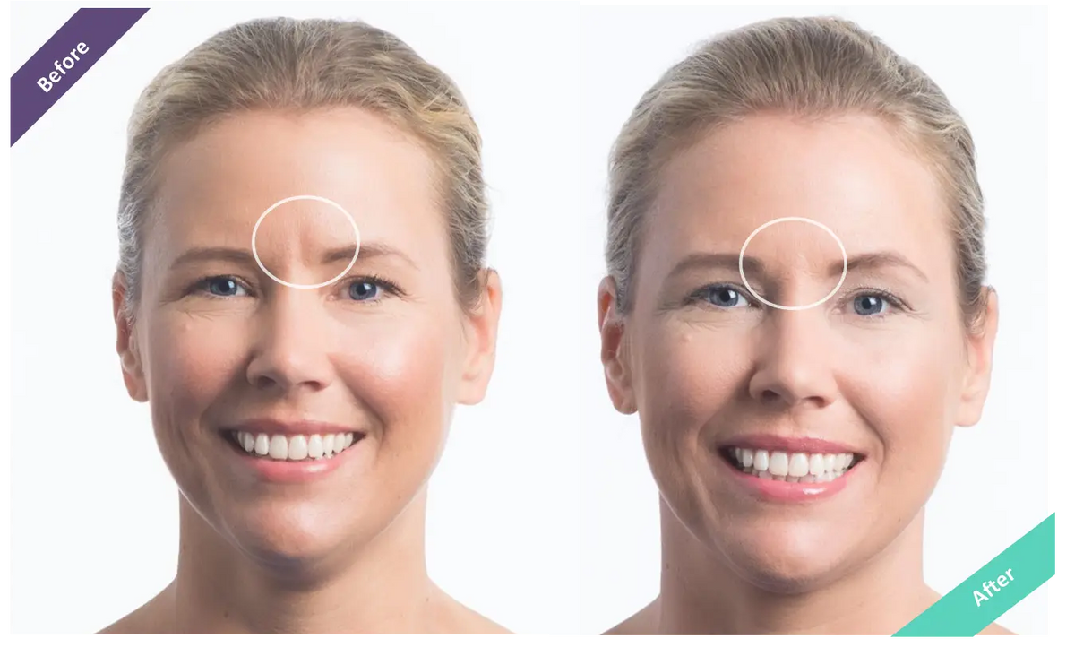 WRINKLE FILLER REVIEW