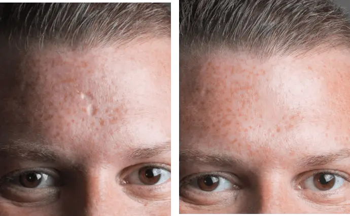 mederma for acne scars