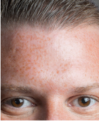 Acne scar filler