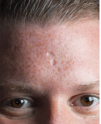 Acne scar filler