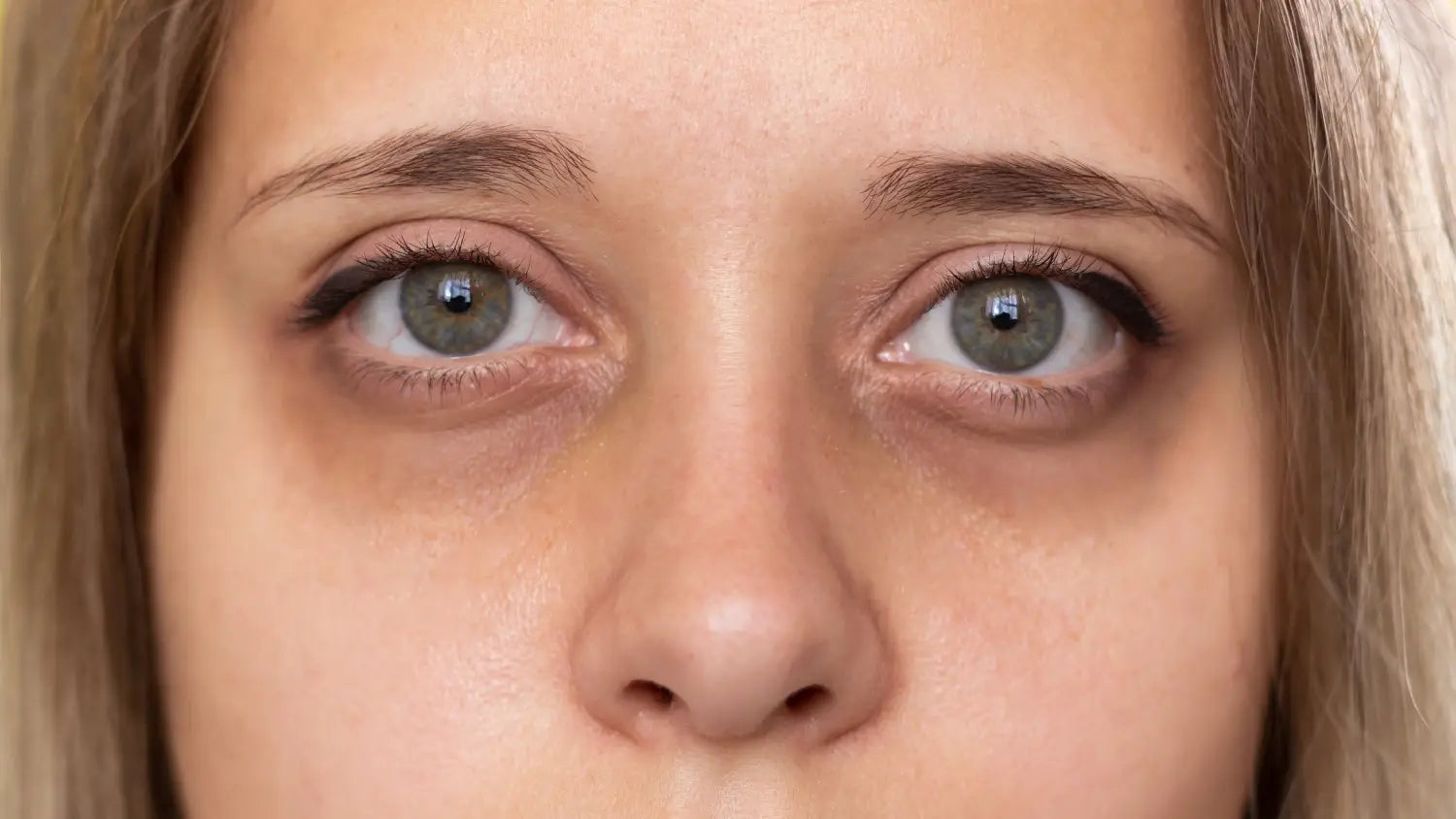 dark circles under eyes