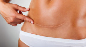 tummy tuck scar