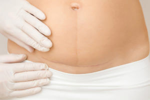 doctor treating tummy scar