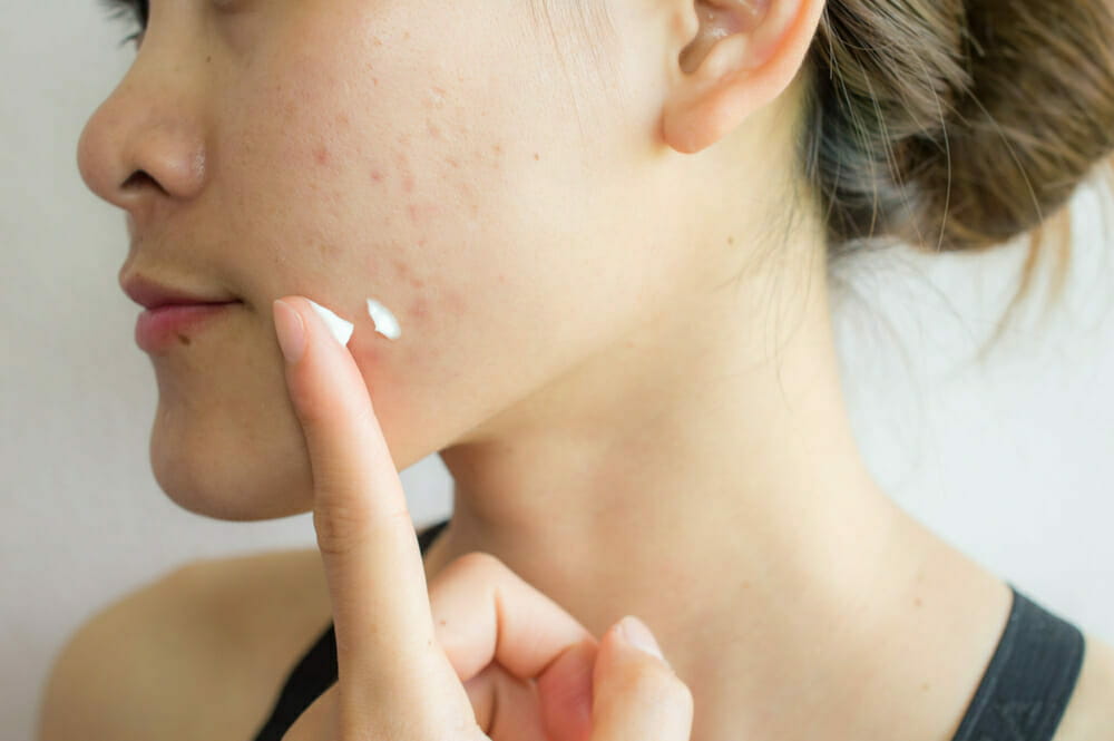 6 Different Types Of Acne Scars And How To Treat