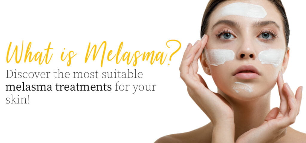 what is melasma